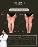 くっつき太もも卒業！✨｜太ももの360°脂肪吸引 after画像 サムネイル用