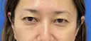 眉下切開術 before画像 サムネイル用