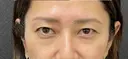 眉下切開術 30日後 サムネイル用