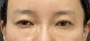 眉下切開術 before画像 サムネイル用