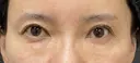 眉下切開術 30日後 サムネイル用