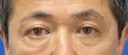 眉下切開術 30日後 サムネイル用
