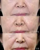 【人中短縮(プレミアムリップリフト)・70代女性】口輪筋の処理と鼻中隔軟骨に固定で手術後の後戻りを抑える。 7日後 サムネイル用
