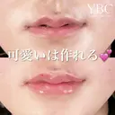【可愛いは作れる💗唇ヒアルロン酸注入💉】 after画像 サムネイル用