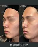 隆鼻術（プロテーゼ）+鼻尖形成+耳介軟骨移植 after画像 サムネイル用