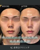 隆鼻術（プロテーゼ）+鼻尖形成+耳介軟骨移植 after画像 サムネイル用