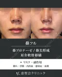 隆鼻術（プロテーゼ）+鼻尖形成+耳介軟骨移植 after画像 サムネイル用