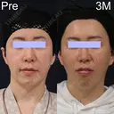 ミッドフェイスリフト before画像 サムネイル用