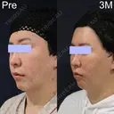 ミッドフェイスリフト after画像 サムネイル用