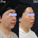 ミッドフェイスリフト after画像 サムネイル用