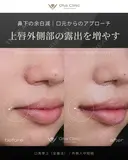 口角挙上（全層法）・外側人中短縮 after画像 サムネイル用