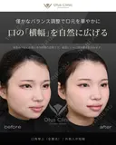 口角挙上（全層法）・外側人中短縮 before画像 サムネイル用