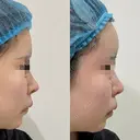 額脂肪注入 before画像 サムネイル用