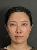 目の下のクマ・たるみ取り、脂肪注入（ゴルゴライン） before画像 サムネイル用