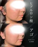 顎　ヒアルロン酸 before画像 サムネイル用