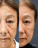 表ハムラ法 after画像 サムネイル用