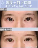 ＜20代・女性＞【二重埋没法マイクロメソッド+α】【目上切開】 before画像 サムネイル用