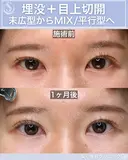 ＜20代・女性＞【二重埋没法マイクロメソッド+α】【目上切開】 30日後 サムネイル用