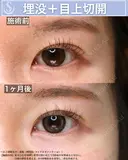 ＜20代・女性＞【二重埋没法マイクロメソッド+α】【目上切開】 30日後 サムネイル用