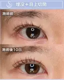 ＜20代・女性＞【二重埋没法マイクロメソッド+α】【目上切開】 10日後 サムネイル用