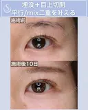 ＜20代・女性＞【二重埋没法マイクロメソッド+α】【目上切開】 10日後 サムネイル用