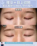 ＜20代・女性＞【二重埋没法マイクロメソッド+α】【目上切開】 30日後 サムネイル用