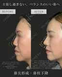鼻尖形成(3D法)・耳介軟骨移植・鼻柱下降(併用)・貴族手術(人工真皮) before画像 サムネイル用