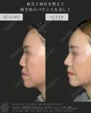 鼻尖形成(3D法)・耳介軟骨移植・鼻柱下降(併用)・貴族手術(人工真皮) 30日後 サムネイル用