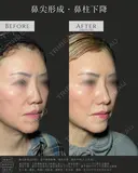 鼻尖形成(3D法)・耳介軟骨移植・鼻柱下降(併用)・貴族手術(人工真皮) 30日後 サムネイル用