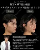 🩵ひらくん院長による🩵小顔脂肪吸引×ナゾラビアルファット除去×糸リフト before画像 サムネイル用