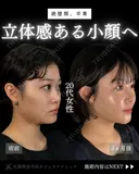 🩵ひらくん院長による🩵小顔脂肪吸引×ナゾラビアルファット除去×糸リフト 90日後 サムネイル用