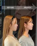 頬顎下脂肪吸引｜糸リフト before画像 サムネイル用