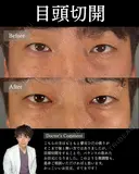 💫ひらくん院長による💫目頭切開 before画像 サムネイル用