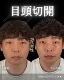 💫ひらくん院長による💫目頭切開 30日後 サムネイル用