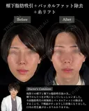 🌟ひらくん院長による🌟小顔脂肪吸引×バッカルファット除去×糸リフト before画像 サムネイル用