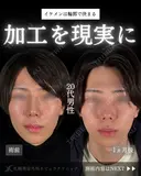 🌟ひらくん院長による🌟小顔脂肪吸引×バッカルファット除去×糸リフト 30日後 サムネイル用