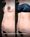 引き締めで理想のお腹へ✨｜お腹の360°脂肪吸引／ベイザー4Dスカルプト before画像 サムネイル用