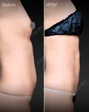 引き締めで理想のお腹へ✨｜お腹の360°脂肪吸引／ベイザー4Dスカルプト after画像 サムネイル用