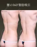 引き締まった美しいくびれ✨｜腰の360°脂肪吸引 before画像 サムネイル用