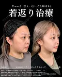 山本の🎀最強小顔術🎀 before画像 サムネイル用