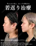 山本の🎀最強小顔術🎀 after画像 サムネイル用