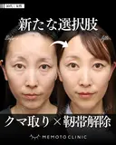 切らないクマ取り(経結膜脱脂法) 30日後 サムネイル用