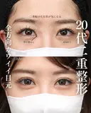 二重埋没法 after画像 サムネイル用