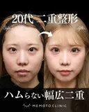 二重埋没法 30日後 サムネイル用