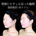 頬・あご下脂肪吸引 /バッカルファット/ジョールファット/糸リフト /エラボトックス/顎ヒアルロン酸 180日後 サムネイル用
