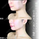 頬・あご下脂肪吸引 /バッカルファット/ジョールファット/糸リフト /エラボトックス/顎ヒアルロン酸 before画像 サムネイル用