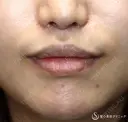 【30代女性・口周りの印象をスッキリ】鼻下短縮術（リップリフト/人中短縮）（1ヶ月後）　 30日後 サムネイル用