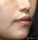 【30代女性・口周りの印象をスッキリ】鼻下短縮術（リップリフト/人中短縮）（1ヶ月後）　 30日後 サムネイル用