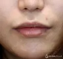 【30代女性・口周りの印象をスッキリ】鼻下短縮術（リップリフト/人中短縮）（1ヶ月後）　 before画像 サムネイル用