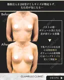 シリコンバッグ豊胸 30日後 サムネイル用